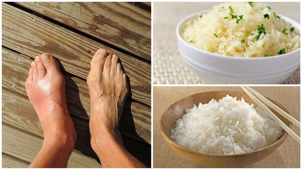 Kihtipotilaille suositellaan riisipohjaista ruokavaliota. 